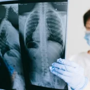 Manilow Health Update - Barry Manilow Health Update: Doctors Find New Lung Made of Platinum Records